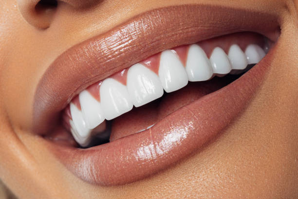 wide smile with white crowns